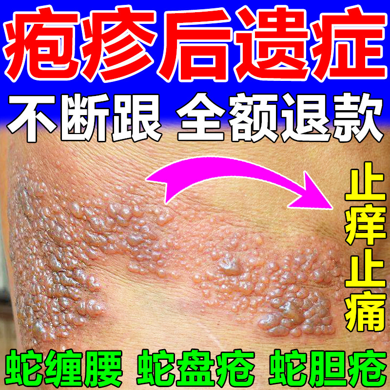 蛇盘疮后遗症神经痛疼外用药带状