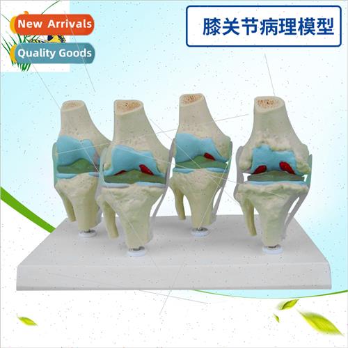 Knee joint-pathology model Joint bone-pathology display Huma