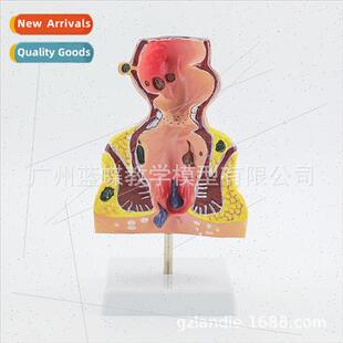 Anorectal disease model human rectal pathology model anal fl
