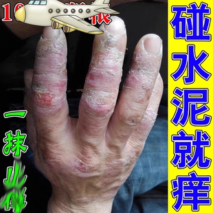 水泥过敏建筑专用手痒脱皮干裂痒起手足