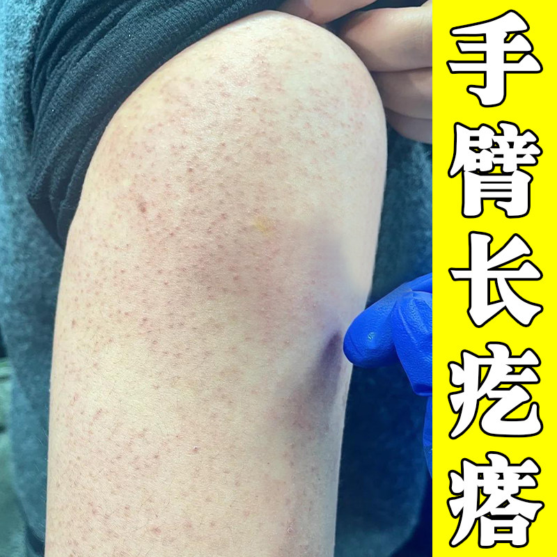 胳膊鸡皮起小黑点腿上鸡皮疙瘩粗糙毛周角化膏