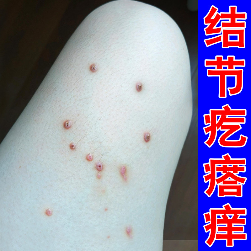 结节性顽固硬疙瘩身上起红疙瘩小腿痒腿上长硬疙瘩外用软膏