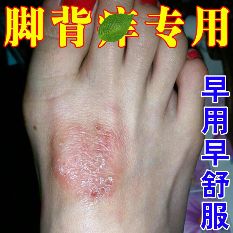 脚背脚面皮肤脚上干燥起皮专用膏