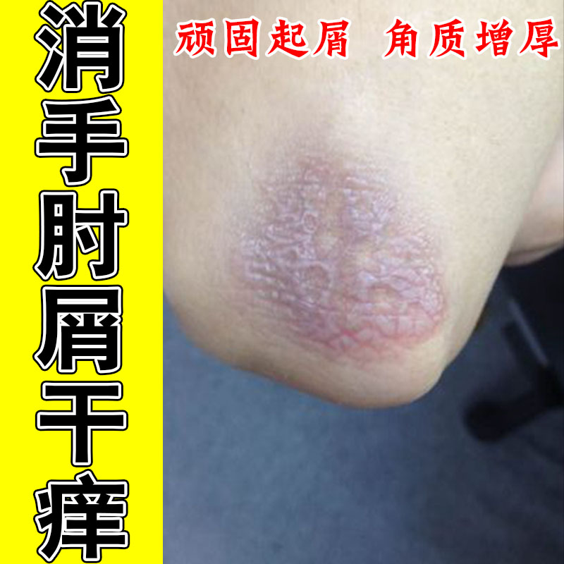 手肘红屑胳膊关节皮肤痒药神经性顽固皮红屑真菌身上起红疙瘩软膏