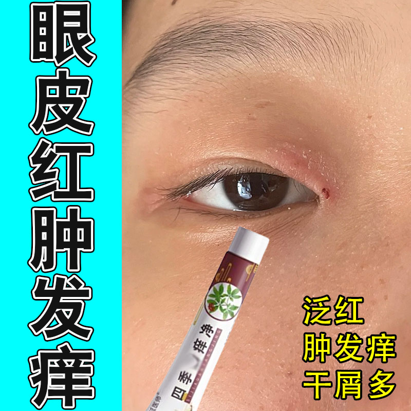 眼皮红斑肿干燥起皮红肿痒眼周眼皮痒起皮掉屑真菌保湿修护软膏