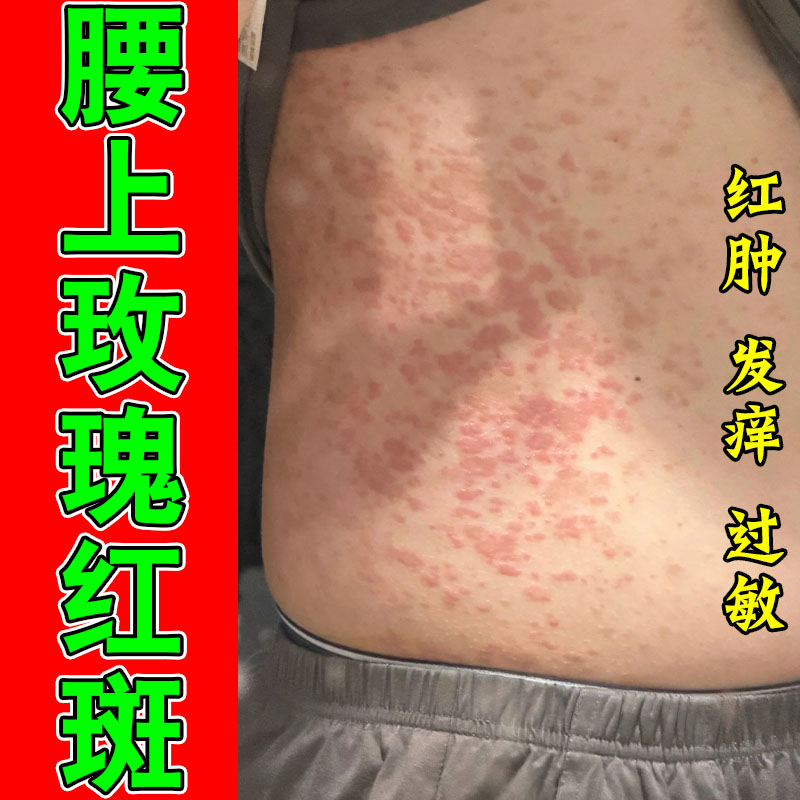 玫瑰红斑身上腿上红斑点起干屑红斑日光性发皮肤过敏保湿软膏