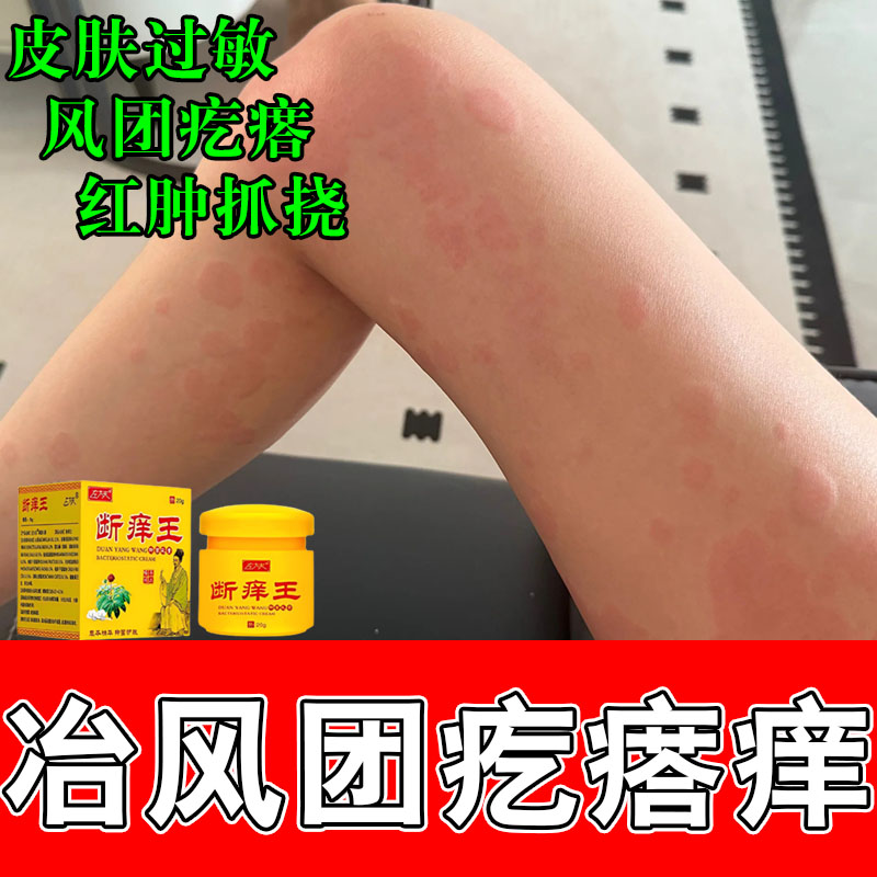 风团躯干手臂疙瘩抓挠划痕泛红凸起皮肤干痒大面积发痒修护膏