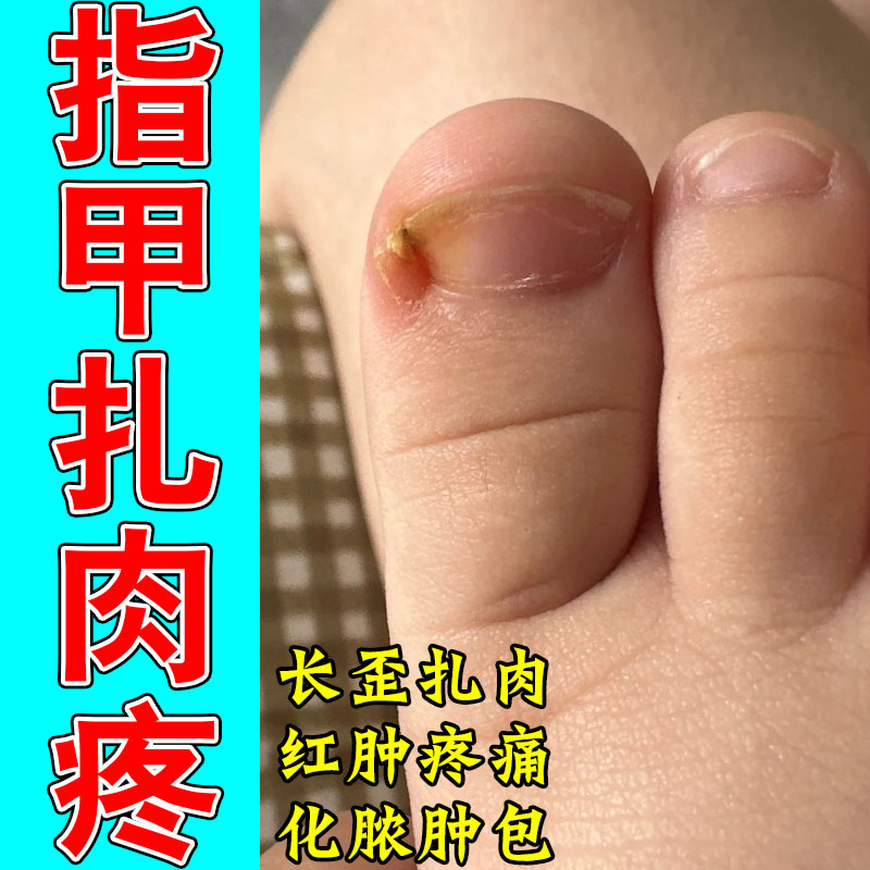 舒缓甲沟红肿疼痛草本修护膏改善嵌甲息肉指甲发软肿大软甲乳膏
