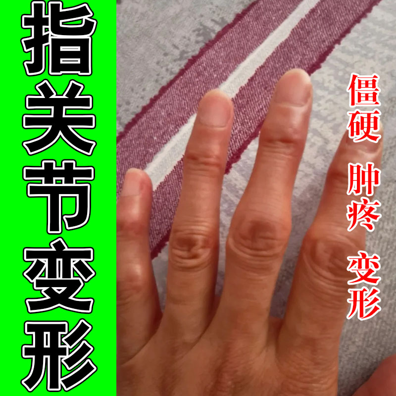手指关节肿大粗大专用老人手指关节弯曲困难僵硬疼痛草本修护膏