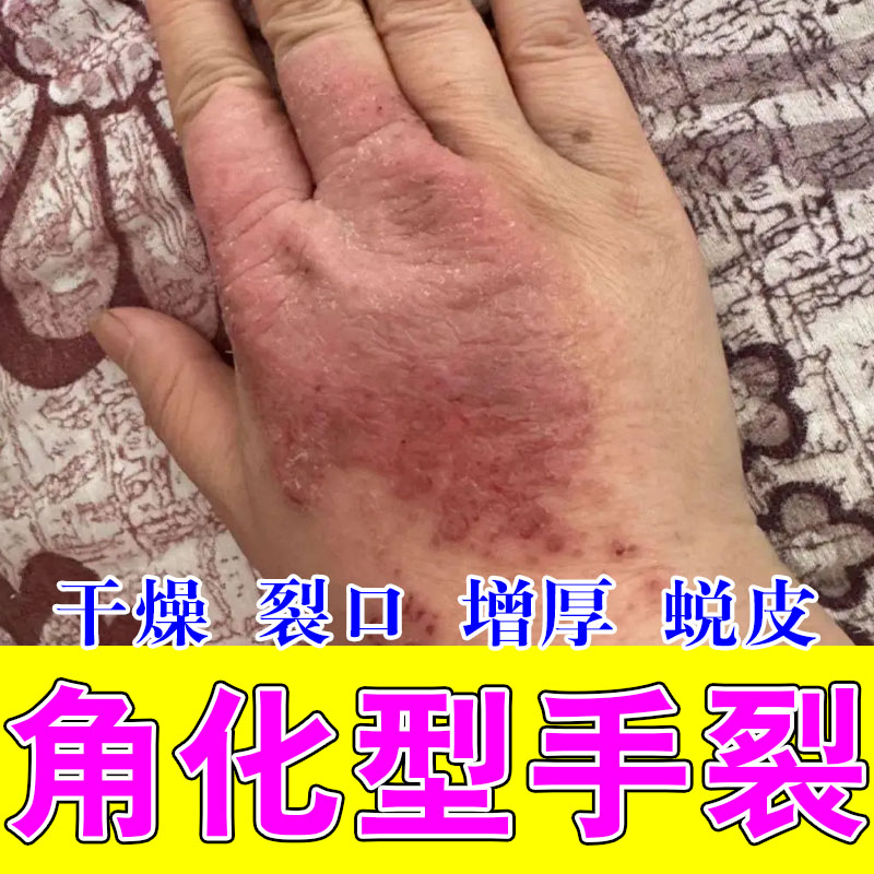 手背红斑凸起硬块发痒红肿过敏干燥起皮温和草本手部保湿乳膏
