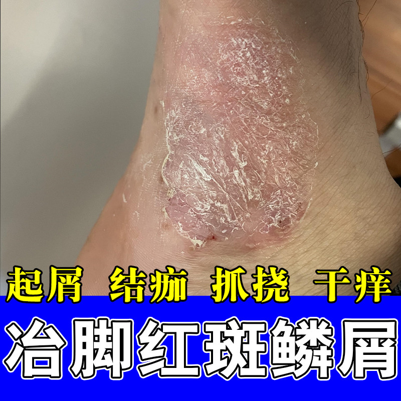 脚侧痒粗糙痒脚侧痒起屑脚面干燥起皮痒疙瘩干痒舒缓温和膏乳