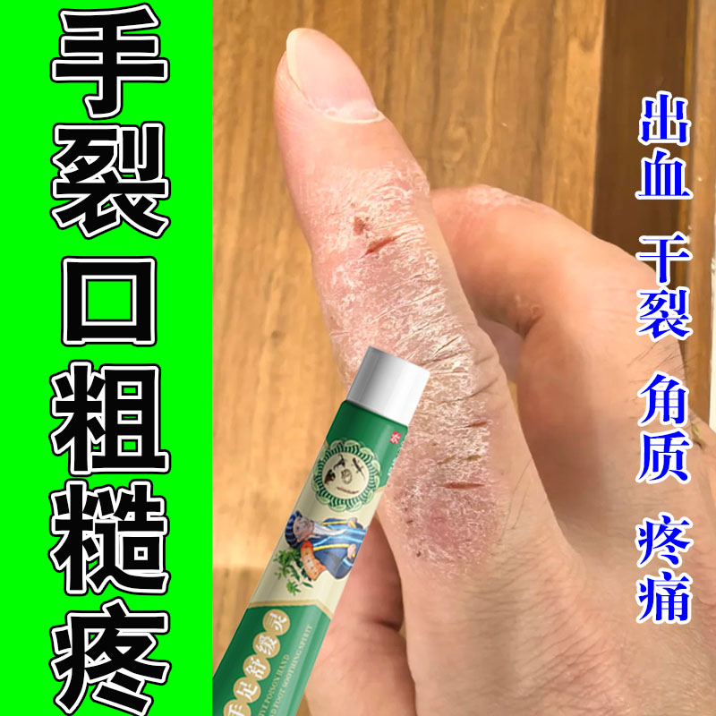 角化型手部干裂痒膏脱皮鹅开裂掌风角质增厚开裂手痒修护膏