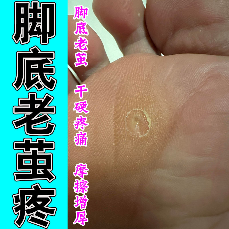 脚趾脚底茧质脚垫脚后跟厚硬茧脚钉足部粗糙角质舒缓修护贴