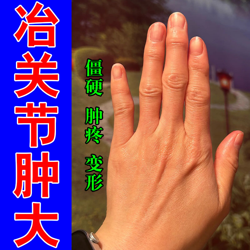 手指粗大指关节手指骨节肿胀鼓包手指僵硬弯曲困难草本修护膏