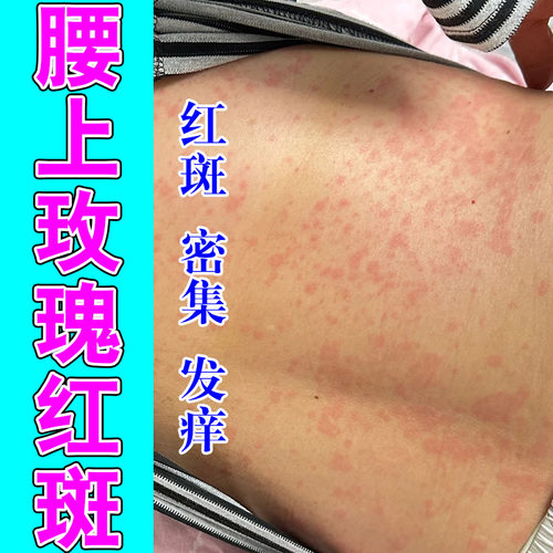 玫瑰红斑皮肤痒过敏红斑起皮干燥起皮红点粗糙痒涂抹修护软膏