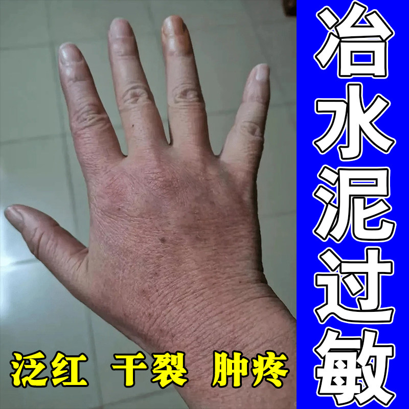 冶工地手干裂脱皮水泥接触过敏红肿干疼植物舒缓草本保湿修护膏