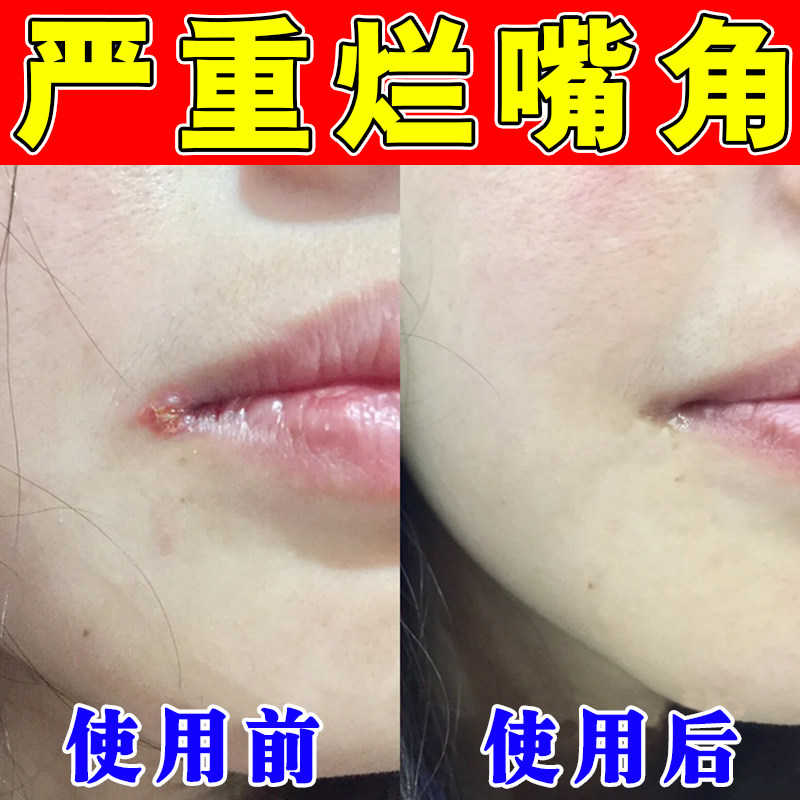 烂嘴角膏嘴巴干裂脱皮上火嘴角开裂起泡红肿口周专用