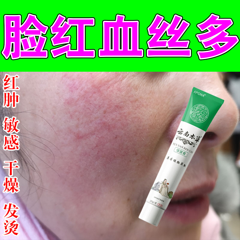 严重脸颊红血丝舒缓脸上红血丝泛红角质层薄过敏草本修护乳膏