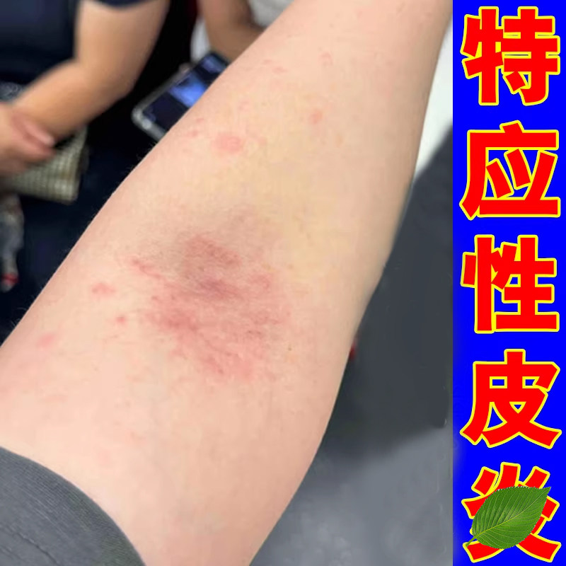 胳膊肘内侧痒起疙瘩小红点夏天天热肘窝