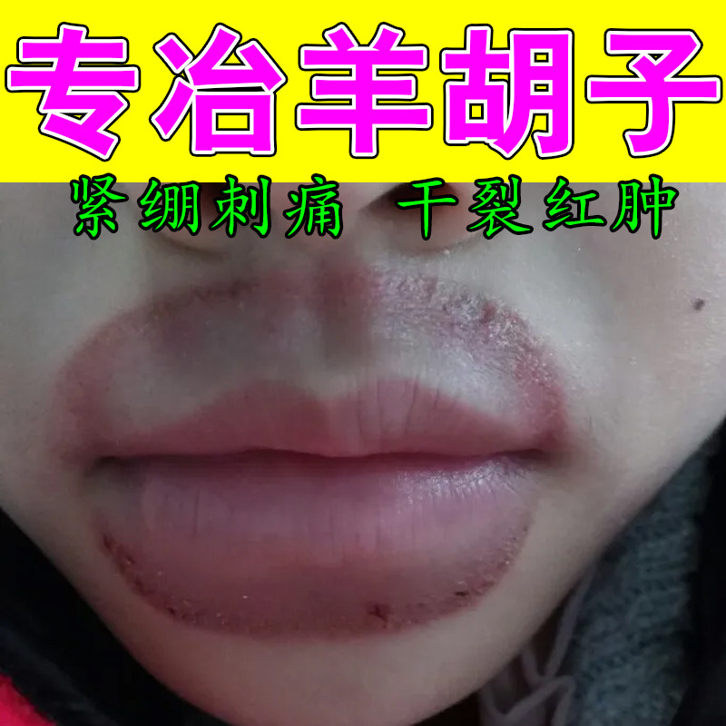 小孩频繁舔嘴羊胡子口周干红发疼干裂泛红肿起植萃润肤保湿膏