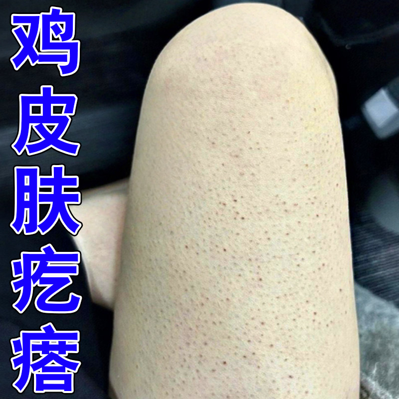 手臂鸡皮小疙瘩毛囊角化身体乳腿上皮肤长密集黑点干燥起皮专用