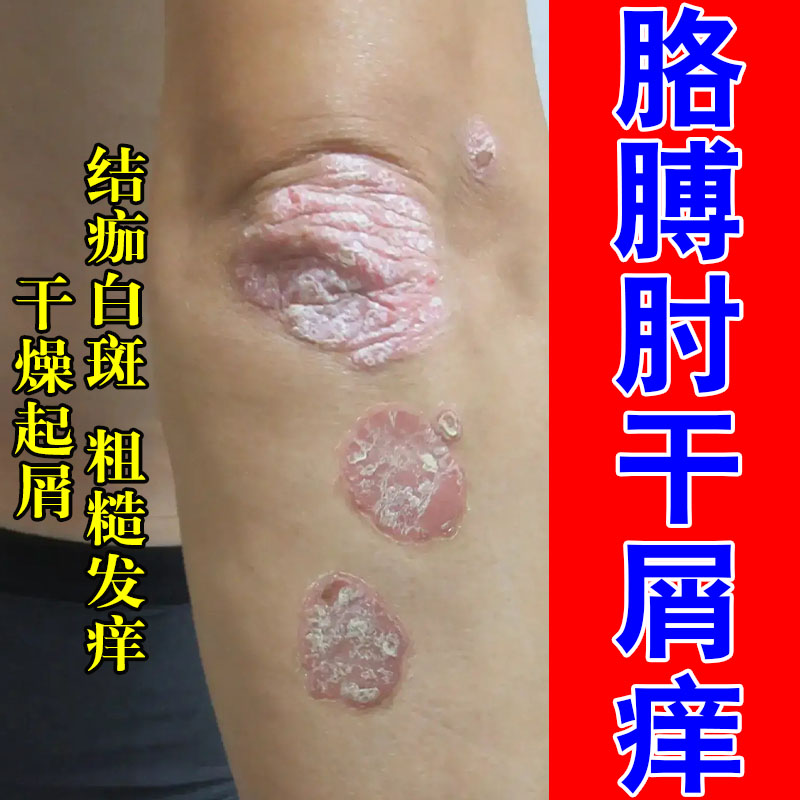 胳膊肘长红屑手肘关节皮肤痒药神经性发肤红起红疙瘩干燥脱屑软膏