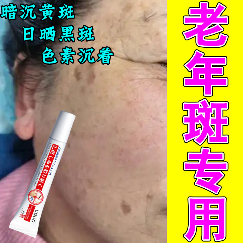 老年身上脸上斑手部面部暗沉成年人黑斑晒斑脸上暗沉修护膏