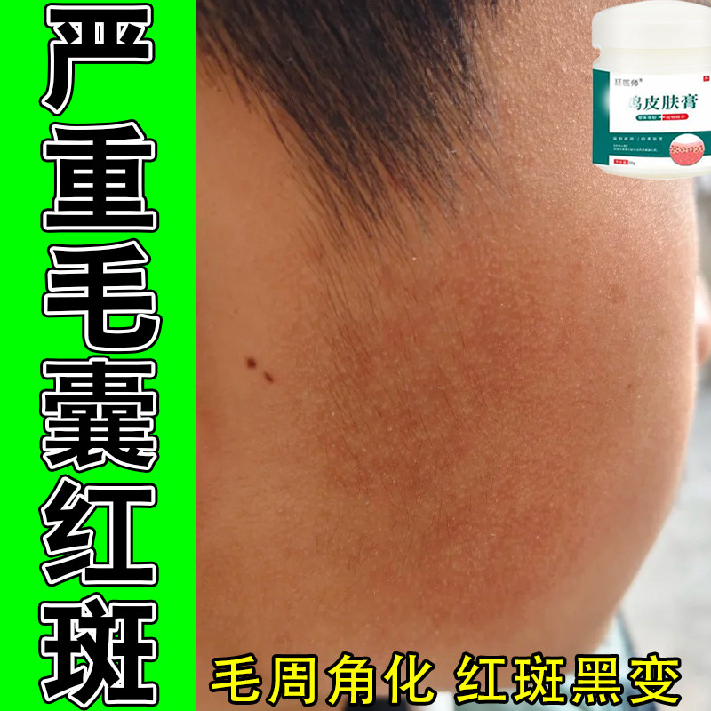 脸上毛囊红斑黑变毛周角化面颊角质颗粒凸暗沉泛红发黑草本修护膏
