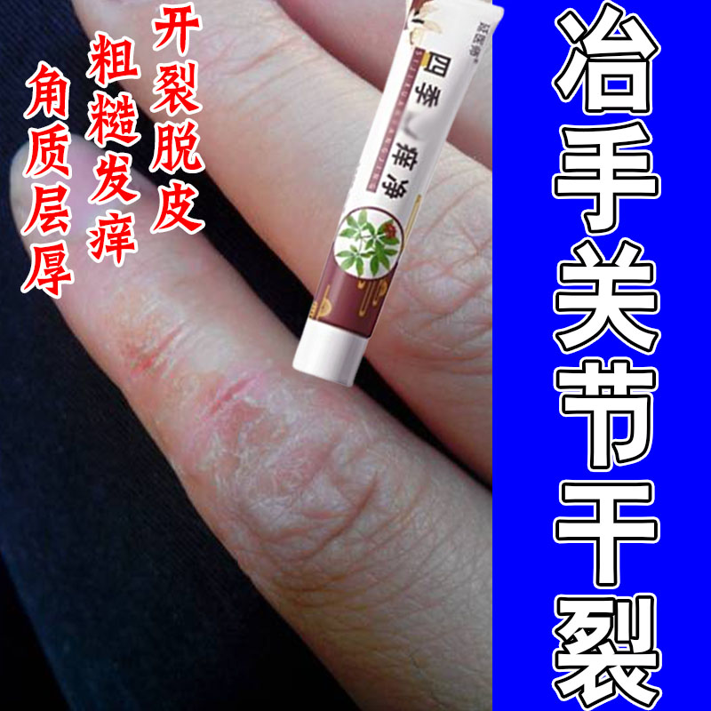 手指关节真菌硬皮开裂口顽固神经皮肤发痒起皮痒保湿疙瘩痒修护膏