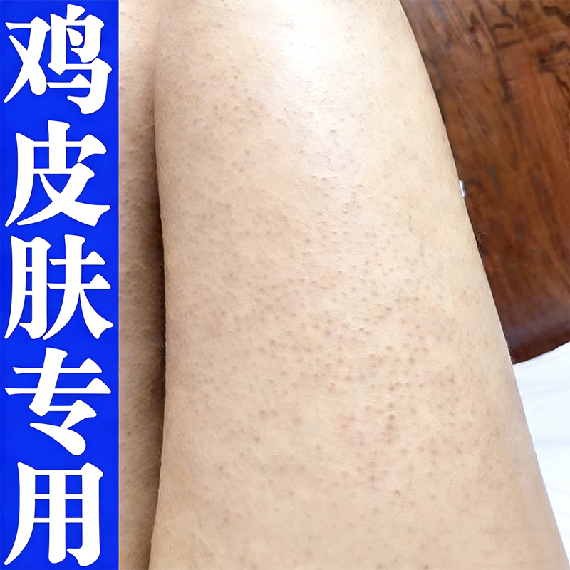 祛除胳膊上颗粒物毛囊堵塞汗毛出不来鸡皮疙瘩身上突起小疙瘩