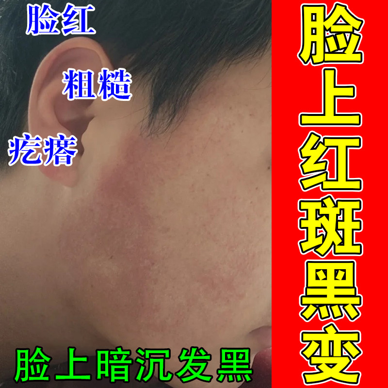 面部毛囊红斑黑变色素堆积角质凸起起皮暗沉泛红黑粗糙草本修护膏