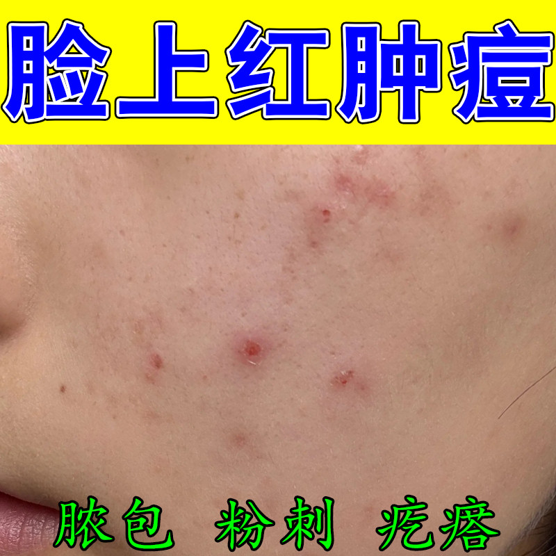 脸颊两侧红肿硬痘干燥起皮保湿成人粉刺疙瘩修护草本萃取霜