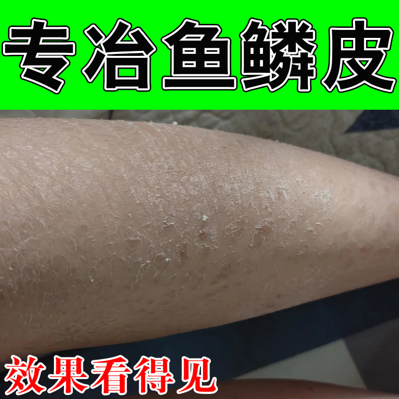 鱼鳞肤起皮粗糙白纹干燥起皮裂纹掉皮屑润肤角质粗糙长效保湿甘油
