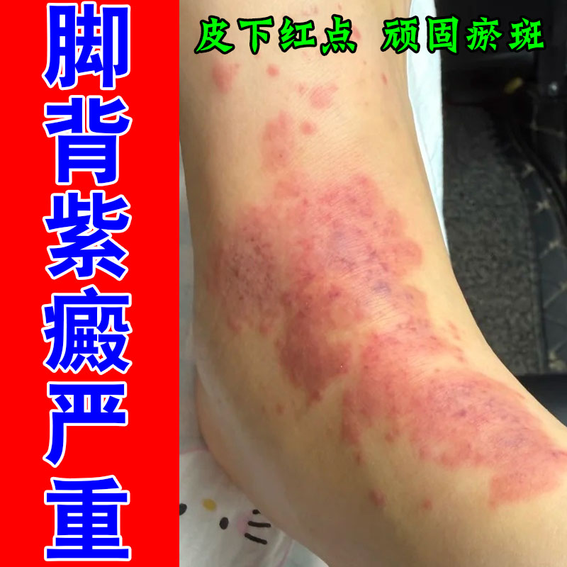 紫癜色素过敏性皮肤淤点红点肌肤色素沉淀外用润肤膏