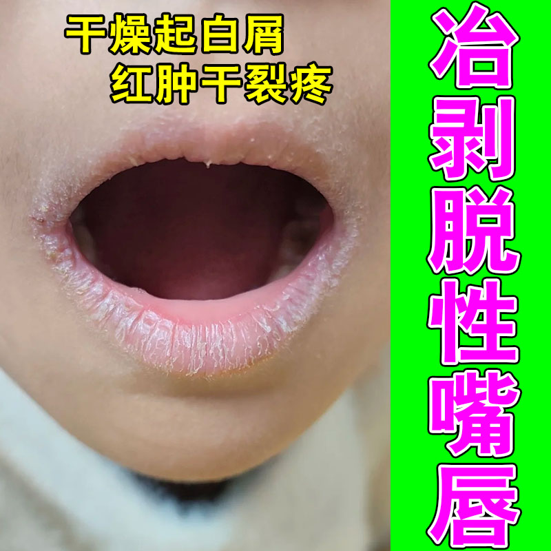 冶唇专用唇膏防嘴唇干裂脱皮修复剥脱性口角用型润唇药