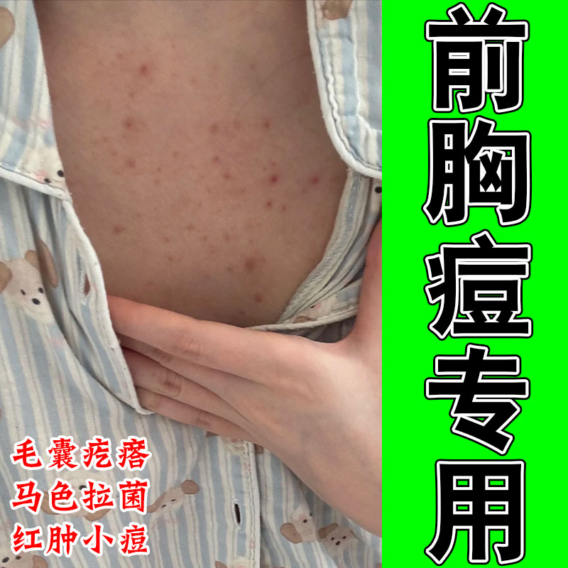 前胸后背马拉色菌毛囊背上长痘皮肤粗糙痒真菌疙瘩修护软膏