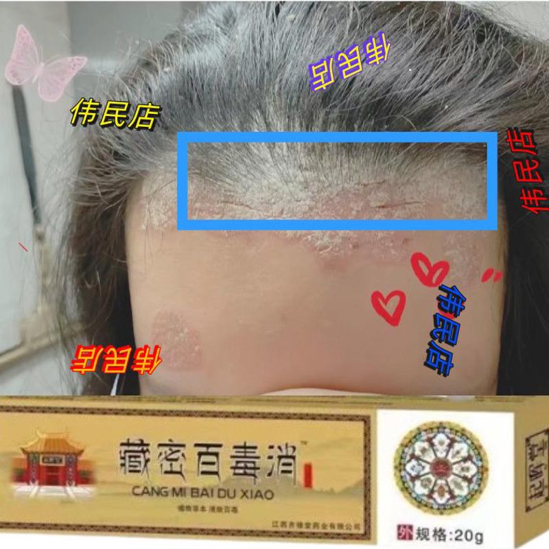 头皮癣感染长癣头痒头头部头癣真菌头上皮脂溢头皮屑严重性皮炎