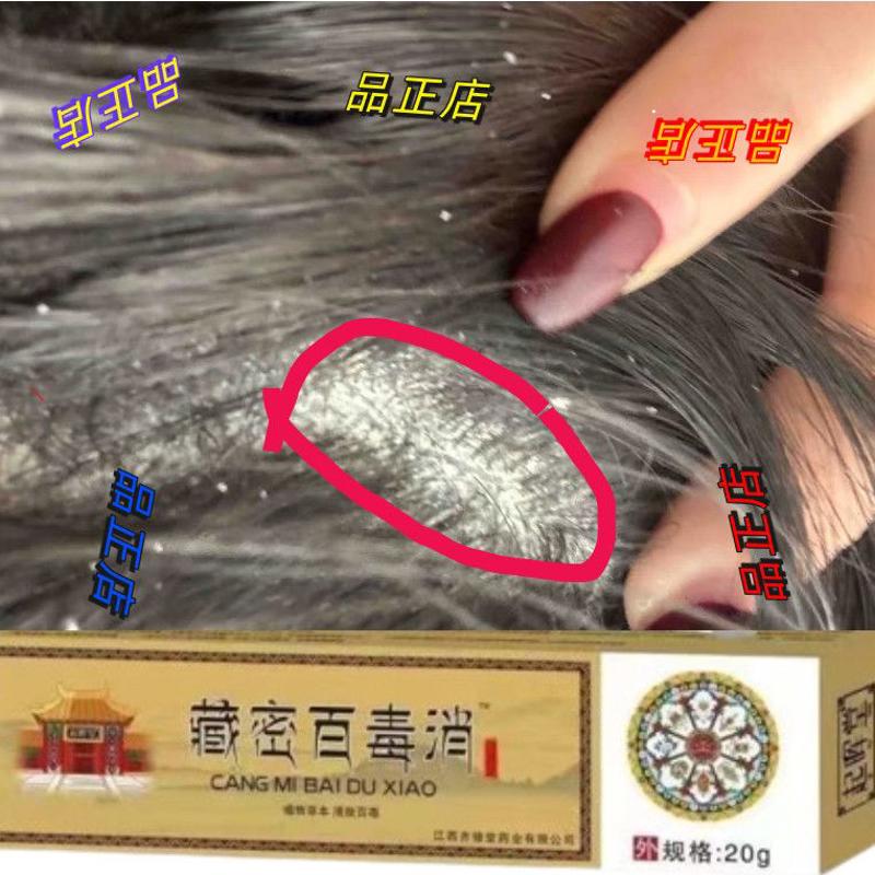 牛皮银屑癣性皮炎头皮头皮屑发红结痂头皮痒疙瘩脂溢头皮硬块头癣