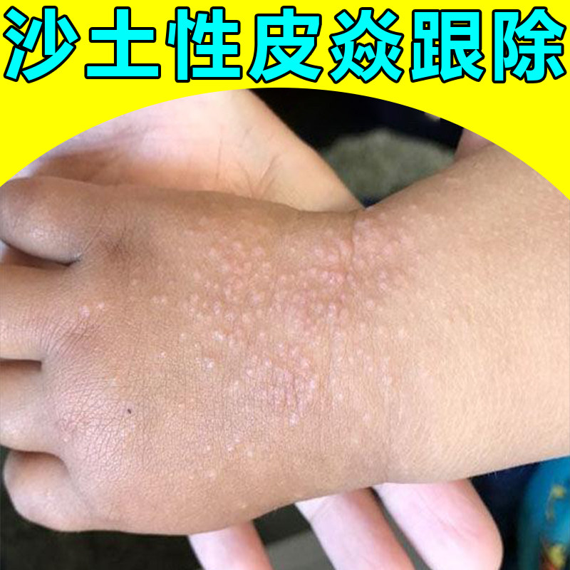 沙土性儿童手上长小疙瘩痒摩擦性身上皮肤专用膏