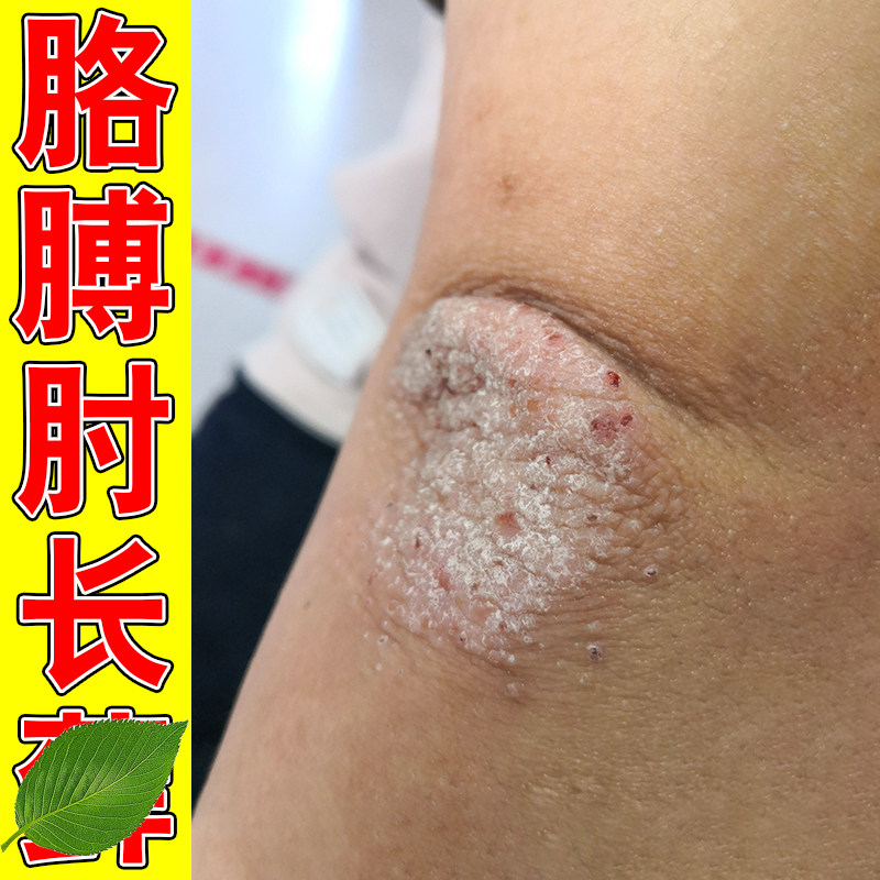 胳膊肘皮肤干燥起干皮粗糙干裂疼起疙瘩