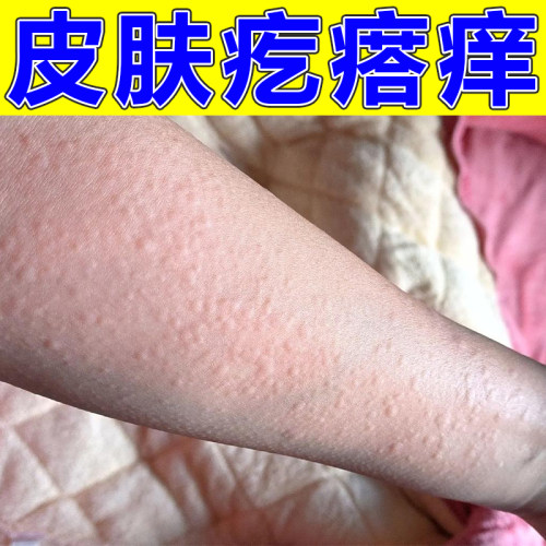 胳膊皮肤干燥痒全身上起红疙瘩腿部发痒起小红点软膏