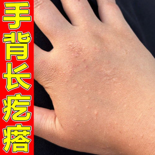 手背发痒手上皮肤起小疙瘩红点干燥起皮开裂口脱皮膏