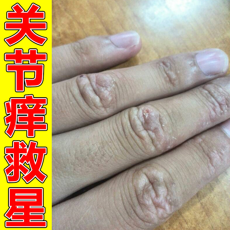 手指关节发痒开裂手指关节长硬疙瘩脱皮干裂口修复膏