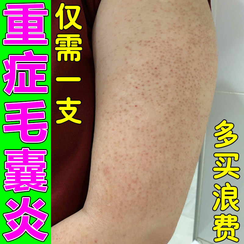 胳膊长疙瘩红点粗糙专用膏去除神器