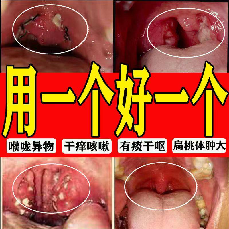 咽炎慢性咽炎除根咽喉炎治疗特效药润喉止咳化痰异物感滤泡专用药
