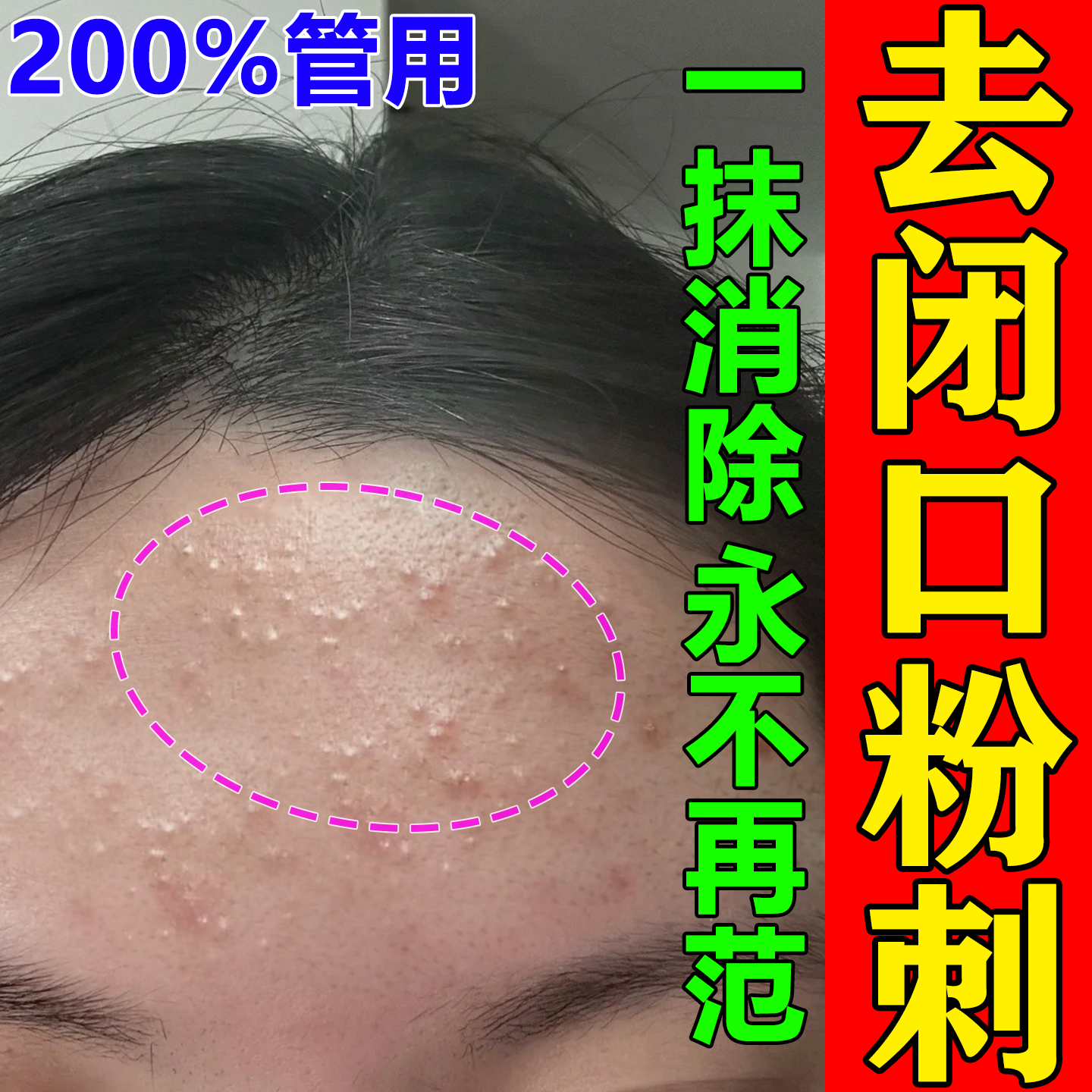 闭口粉刺的克星 脸上长痘痘脓包毛囊炎起小疙瘩 去额头闭口脂肪粒