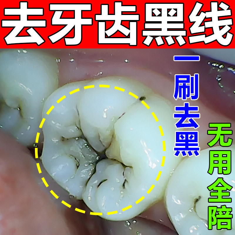 牙齿去黑线黑渍牙窝沟清洁蛀牙菌斑牙缝发黑牙膏粉去除黄口臭美白