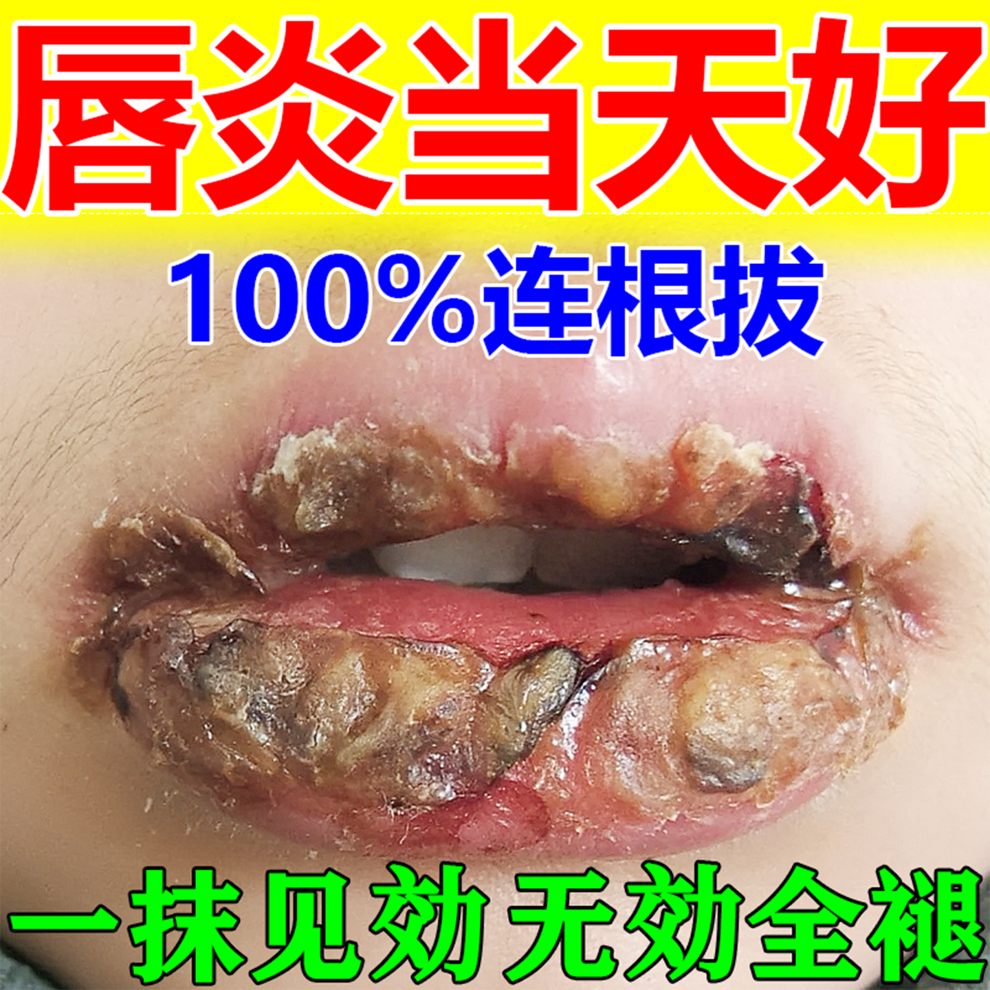 云南本草唇炎润唇专用药膏治嘴唇干裂起泡脱皮嘴角裂保湿滋润男女