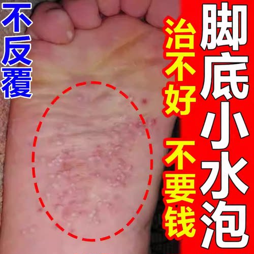 脚底上起小水泡又痒又脱皮脚痒掉皮烂脚丫根脚止杀菌药气水疱型
