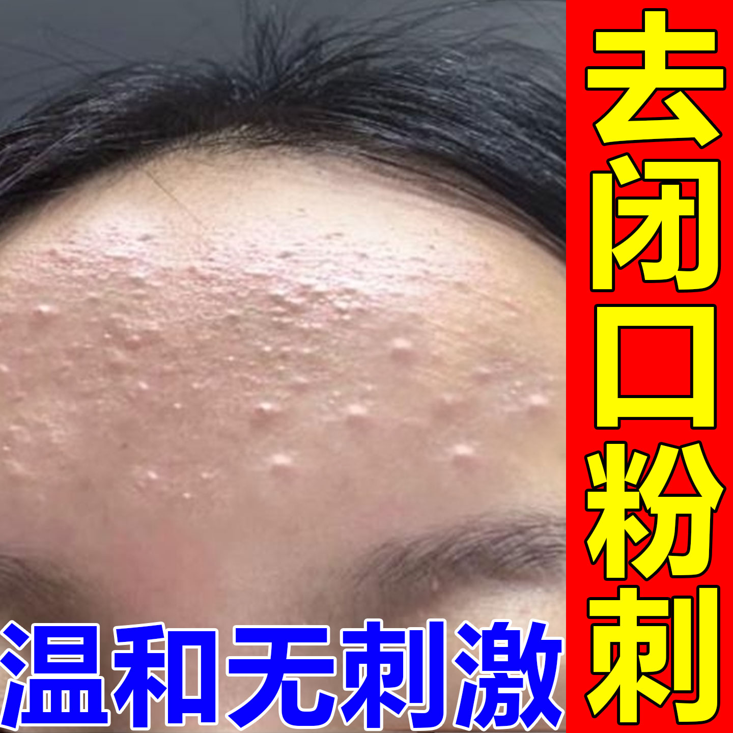 额头闭口粉刺的克儿星治脸上起小乳液/面霜